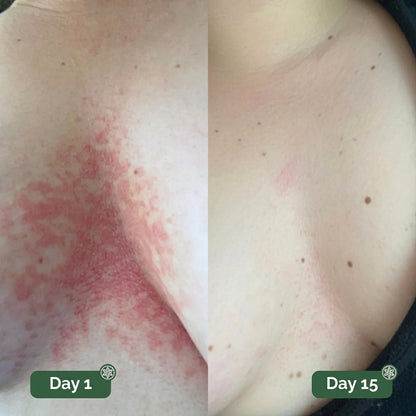 Antifungal Cleansing Soap for Skin Folds